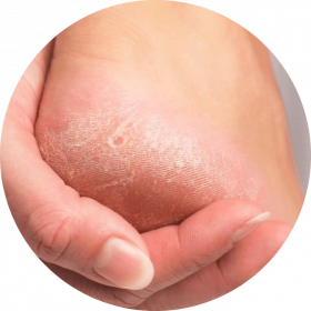foot with calluses